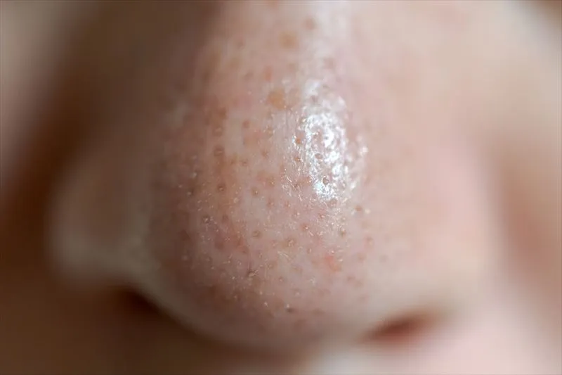 毛穴が開く原因は？