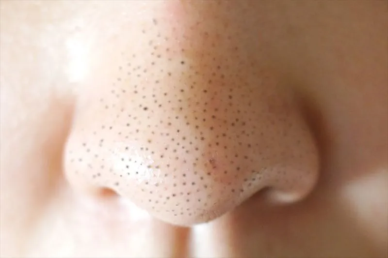 毛穴の黒ずみを改善する方法をご紹介