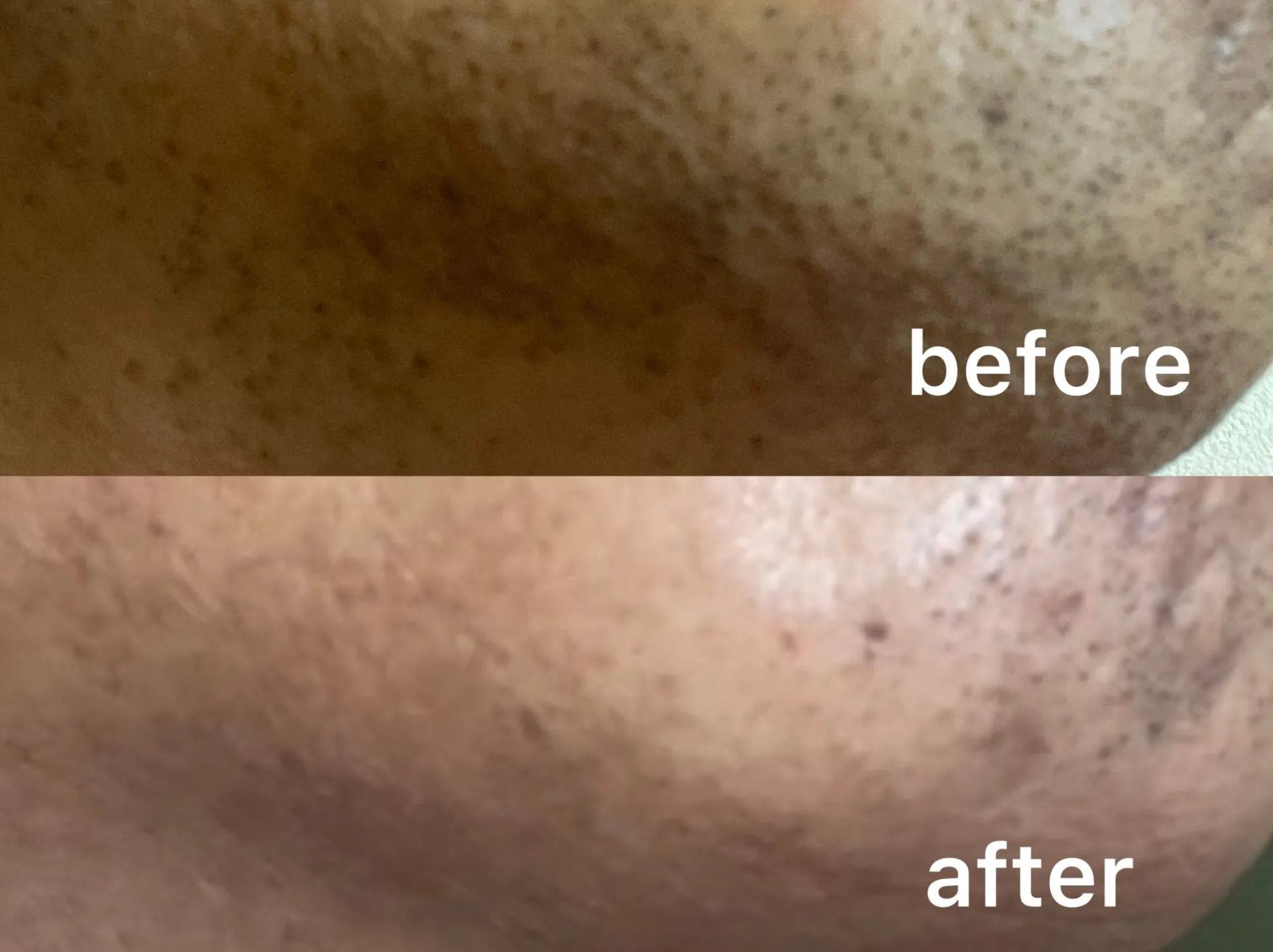 髭脱毛８回目（40代男性）