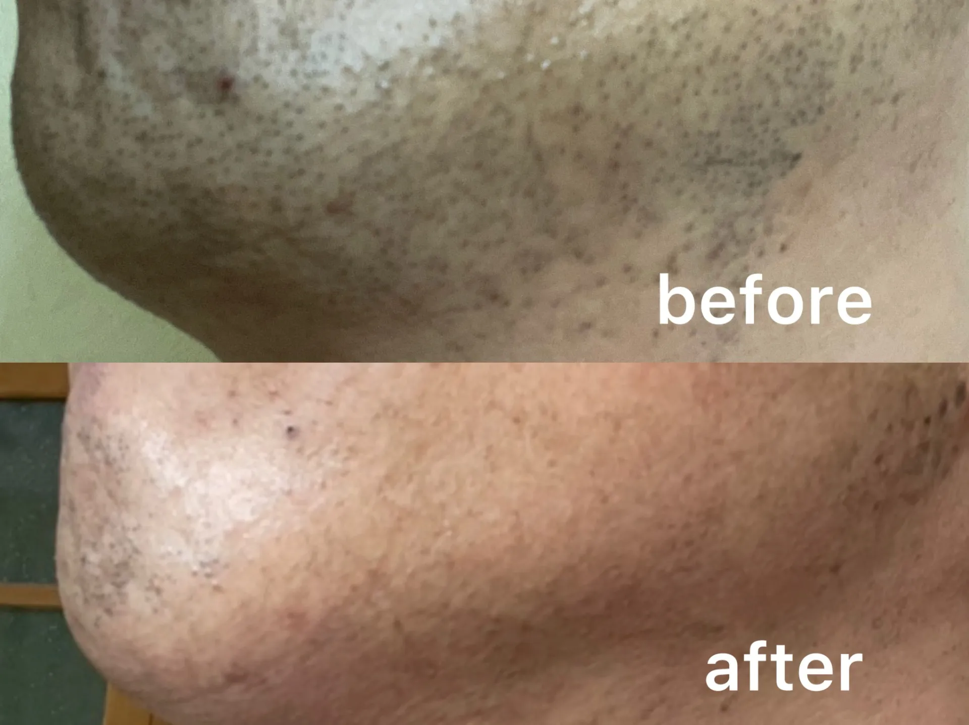 髭脱毛８回目（40代男性）